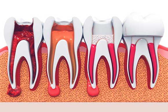 This is Service Root Canal Treatment